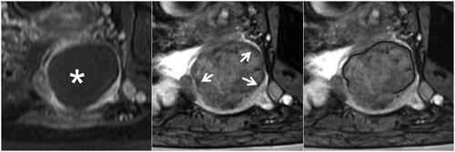 Figure 4. The partial hypointense peripheral rim on SWI. The left, Middle, and right figures are the CE, SWI imaging, and SWI sketch of the same leiomyoma. (Left) The axial CE imaging shows the range of ablated necrotic lesions, which appear as a non-enhancing hypointense zone (star). (Middle) the corresponding axial SWI shows a partial hypointense peripheral rim (arrow). (Right) The sketch map illustrates the range of the hypointense peripheral rim (black line); it involves 50%–90% of the circumference of the ablated zone.