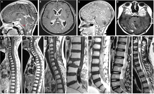 Figure 3 Representative radiographic panel of NM classification. (A–D) The intracranial NM subtypes. (A) The sagittal T1WI with enhancement showing the disseminated medulloblastoma on the surface of leptomeninges as the filament pattern (red arrow). (B) The axial enhanced T1WI displaying the procumbent-shape metastatic glioma located at the internal walls of the lateral ventricle. (C) The sagittal contrasted T1WI showing lots of nodular metastases in the subarachnoid spaces which were less than 1 cm. (D) The axial T1WI with enhancement presenting the two massive round metastatic anaplastic ependymomas in the subarachnoid cisterns. (E–K) The intraspinal NM subtypes. € The sagittal whole spine MRI showing the LI subtype, the leptomeningeal linear enhancement with diffuse miliary medulloblastoma. (F) The sagittal T1WI with contrast exhibiting the metastatic medulloblastoma with extensive distribution in the cervical, thoracic and lumbar leptomeninges, classified as the LIIa subgroup. (G) The sagittal cervical MRI with enhancement showing the LIIb subtype, which was located in the procumbent pattern with a narrow base in the subarachnoid space of C5–C7 level. (H) The sagittal enhanced T1WI displaying the multiple nodular NM located in the cauda equine, classified as the NI subtype. (I) The sagittal T2WI showing the giant metastasis with irregular boundary filling the entire lumber and sacral canal, identified as the NIIa subtype. (J) The sagittal T2WI presenting the NIIb NM as the massive tumor with distinct borders in the sacral canal. (K) The sagittal T2WI showing some intramedullary metastases in the cervical and thoracic spinal cord.