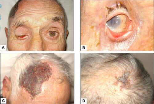 Figure 2 Giant cell arteritis with subatrophy of the right eyeball as a consequence of the ophthalmic artery occlusion (panels A and B). In addition to constitutional symptoms, the patient complained of persistent headaches and scalp tenderness. Three weeks later, one large and one smaller eschars appeared on the scalp that eventually resulted in cicatricial areas of alopecia (panels C and D).