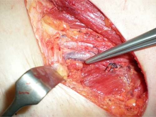 Figure 1 Groin node dissection with preservation of the saphenous vein.