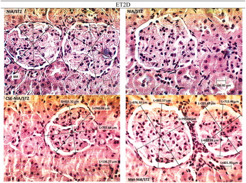 Figure 5. H & E stained kidney histopathology micrographs of NIA/STZ (ET2D) group of rats before and after treatment with CSE and metformin (×400). E-T2D caused extensive irregularity in the glomerular basement membrane (GBM) and mild scleronecrosis. Treatment with CSE and metformin seemed to improve the condition.