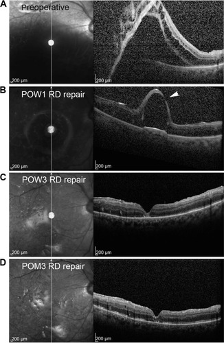 Figure 1 Spectral domain optical coherence tomographic images with corresponding scanning laser ophthalmoscopic images of the left macula.