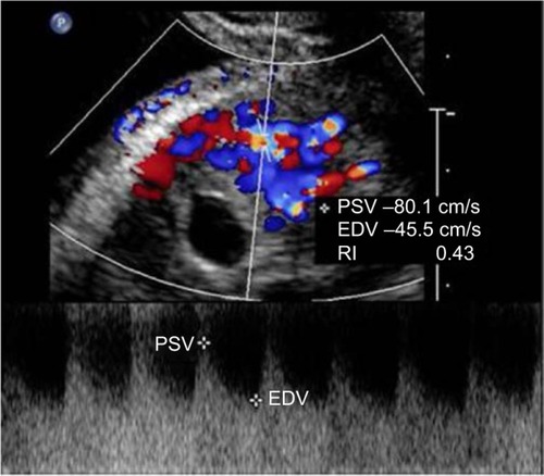 Figure 2 Doppler waveforms of peritrophoblastic blood flow.