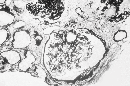 Figure 2. Renal histology illustrating global sclerosis in 2 glomeruli and arteriolar hyalinosis at 2 o'clock (Methenamine silver stain).