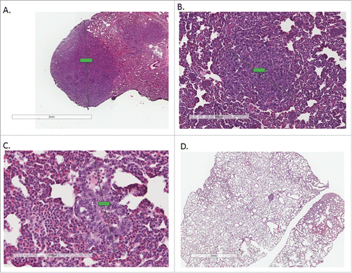 Figure 3. Tissue sections from lungs in each of the treatment groups were H&E stained and examined for presence of visible metastases. Each tissue section was examined and the largest visible lung nodule was measured on its largest axis in each treatment group. Metastases in the AL group (A) were imaged at 2X, AL+IR and CR group at 4X (B and C) and CR+IR group at 10X (D) for data collection purposes. Nodules from the AL mice appeared larger and more frequently on histology when compared with other treatment groups. On average, mice in the CR+IR group had the smallest and least number of metastases on histology as evidenced by one micrometastasis seen on tissue section (D).