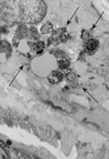 Fig. 1 Rectal mucosa. Perivascular smooth muscle cell showing fingerprint inclusions (arrows). TEM. Original magnification, × 6,000.