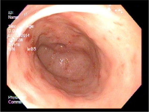 Figure 7 Upper endoscopy before therapeutic intervention with radiofrequency ablation.