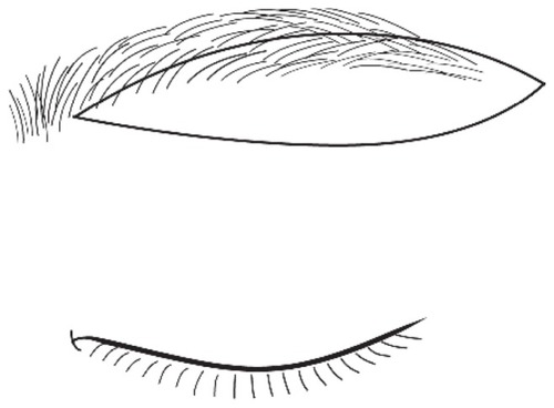 Figure 1 Design of extended IBEB. The medial end of the excised skin pad is 5 mm laterally in from the start of the eyebrow, and the lateral end of the skin pad is 5–10 mm laterally out from the tail of the eyebrow. The incision is made perpendicularly to the hair shafts. The vertical width of the skin pad is 10–20 mm at its widest point in most patients.