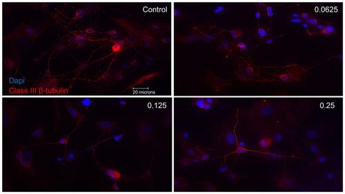 Figure 3 Morphological effect of different concentrations of ranibizumab on retinal ganglion cells (RGCs) following 72 hrs post-treatment. RGCs were stained for nuclei (blue) and Class III β-tubulin (red). Immunofluorescence of RGCs under different concentrations of ranibizumab for 72 hrs showed that as the concentration increased, the morphology of the RGCs continued to change. As the concentration went from untreated control to double the clinical dose (0.25 mg/mL), the amount of RGCs showed a further decrease in number, had fewer contacts between each other and had fewer dendritic outgrowths. Magnification x60. Scale bar: 20 µm.