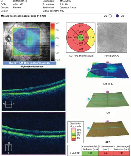 Figure 5 The macular thickness map, which was generated by means of OCT after 3 months since CRA occlusion, demonstrated thinning along the distribution of three cilioretinal arteries.