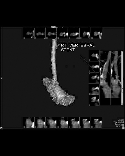 Figure 4 Computed tomographic angiogram with three‐dimensional reconstruction image of the right vertebral artery performed six months after the percutaneous intervention showing patency of the right vertebral stent.