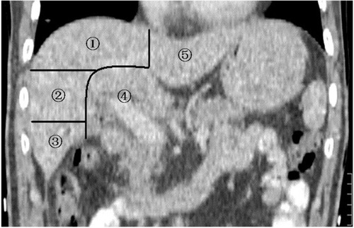 Figure 1 Coronal CT image of the five lobes of the liver.