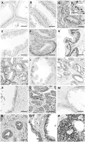 Figure 1. Expression of Bcl-2 (A–D), Bcl-xL (E,F), Mcl-1 (G,H), Bax (I,J), Bim (K,L), Bad (M,N) y PUMA (O,P) in normal prostate (A,H), BPH (B,E,G,K,M,O) and prostate cancer (C,D,F,H,J,L,N,P). Scale bars: 30 μm (O,P), 25 μm (A,B,G,I,J,K) and 20 μm (C,E,F,H,L,M,N), 15 μm (D).