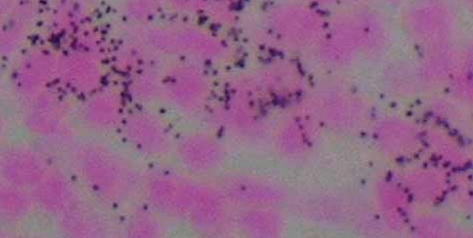 Figure 1 Autoradiographic localization of 90Y-ibritumomab tiuxetan from lymph node on a patient sampled 4 days after treatment.