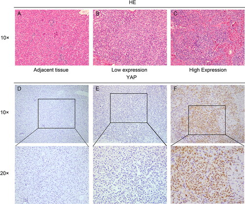 Figure 1. YAP immunohistochemistry in hepatoblastoma tissues and paraneoplastic tissues. YAP expression was primarily localized in the nucleus. A, B and C are hematoxylin and eosin stained, (D) Adjacent tissues (x100). (E) Negative stain in HB (x100). (F) Positive stain in HB (x100).