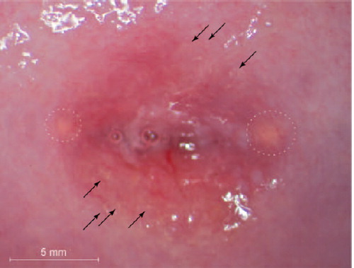 Figure 1. Female genital schistosomiasis lesions. This figure shows an image from a photocolposcopic examination. Single grains are seen in the ectocervical mucosa (arrows point at examples). Nabothian cysts are also seen in the transformation zone (dashed circles). The image was captured using an Olympus OCS 500 colposcope with a mounted Olympus E-420 10 megapixel (MP) single lens reflex camera. Urine microscopy as well as urine PCR was negative for S. haematobium ova. However, Schistosoma PCR in cervico-vaginal lavage was positive. STI tests were negative except for HPV and HIV. The Pap smear showed LSIL.