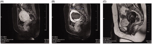 Figure 1. Preoperative and postoperative MRI. (A) Enhanced MRI image of diffused adenomyosis before treatment, which shows that the myometrium of the posterior uterine wall was thickening with a rich vascular supply. (B) Enhanced MRI image acquired for a patient with adenomyosis 1 d after HIFU ablation, which shows a non-perfused region in the lesion. (C) T2WI image obtained 6 months after HIFU ablation for a patient with adenomyosis, which shows complete resolution of the glandular lesions and that the uterus almost recovered to its normal size.