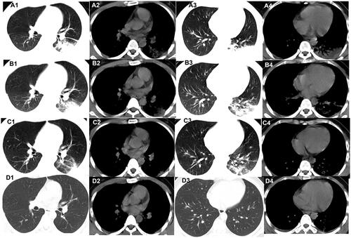 Figure 2. Evolution of consolidationon chest CT of patients with COVID-19. A 45-year-old male Wuhan resident presented with fever and cough for 3 days. (A1–A4) The first non-contrast-enhanced chest CT revealsconsolidation and air bronchogram in the left lower lobe (initial chest CT). (B1–B4) Follow-up chest CT 4 days after the first shows that both the scope and density of the lesions decrease (stage I*). (C1–C4) Follow-up chest CT 8 days after the first shows that both the scope and density of the lesions decrease further (stage II*). (D1–D4) Follow-up chest CT 12 days after the first shows that the lesions are almost absorbed completely (stage III*). *The stage does not represent the course of COVID-19 but the time interval between the two adjacent CT scans.