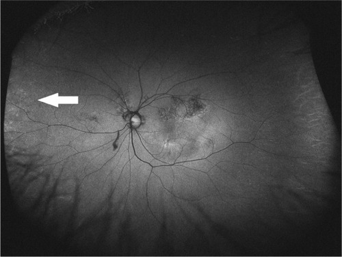 Figure 3 Optos® image of an eye with granular pattern from a wet age-related macular degeneration patient.
