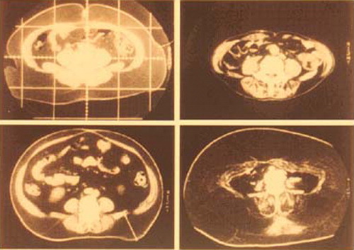 Figure 1. CT scanning images of obese subjects. Note the huge amount of subcutaneous fat in the lower right panel(D). Note also the relatively small amount of subcutaneous fat but massive intra‐abdominal visceral fat in the lower left panel (C).