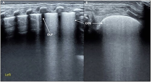 Figure 4. Grade I RDS. Grade I RDS patient. LUS showed GOS-like lung consolidation in the last two intercostal spaces of the left lung and DLP between its upper and lower lung fields (A). GOS was more typical when the probe was scanned along the intercostal space in parallel (B).