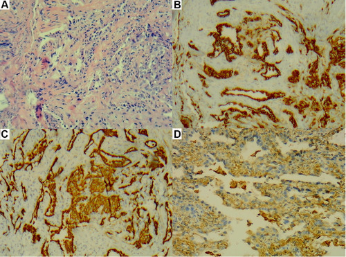 Figure 2 (A–D) There were tumor cells in the upper right lobe, some of which were glandular and micropapillary. (A) HE staining, ×200. (B) CK (+), ×200. (C) CK7 (+), ×200. (D) Napsin A (+), ×200.