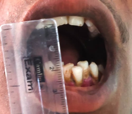 Figure 6 Decreased mouth opening in patient with advanced-stage oral submucous fibrosis.