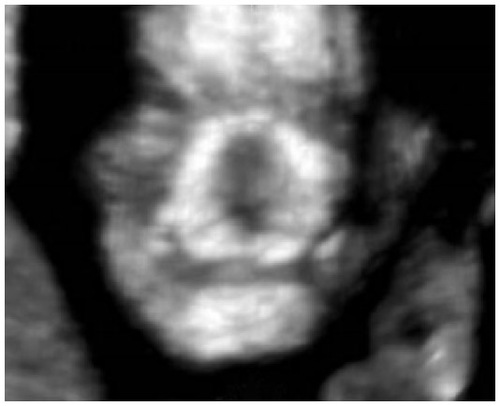 Figure 2 First trimester fetus with micrognathia: this image shows the absence of the mandibular gap.