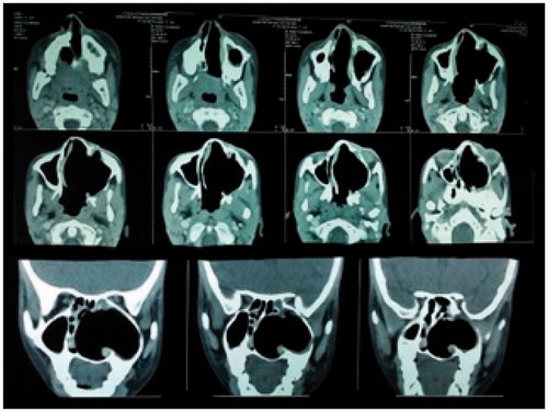 Figure 8. Post-operative CT PNS after 4 weeks.