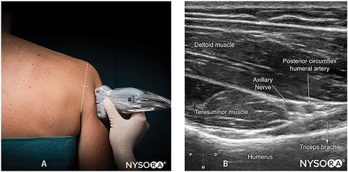 Figure 5 (A) Ultrasound transducer placement for accessing the axillary nerve; (B) Ultrasound image of the axillary nerve. Source: NYSORA.com. In compliance with ethical and academic standards, we acknowledge NYSORA, Inc. for granting permission to use the images in this article for educational purposes. All rights to these images remain with NYSORA, Inc.
