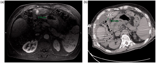 Figure 1. (a) Preablation contrast enhanced MRI demonstrates an arterially enhancing HCC. The liver capsule adjacent to the HCC is 3 mm from the adjacent colon. (b) Intraablation noncontrast CT performed after hydrodisplacement demonstrates that the colon has moved, now 16 mm from the liver capsule. The fluid thickness in this case is 13 mm. Notice also the two microwave antennae which have been placed.