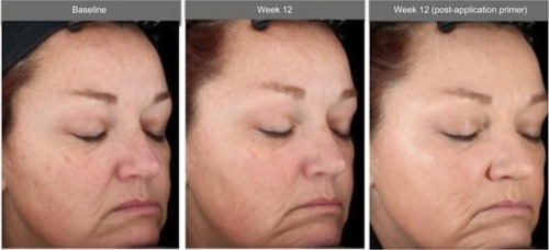 Figure 5 Photographs of a 49-year-old subject with Fitzpatrick skin type III: baseline (left photo) and after 12 weeks of test product (without primer applied [center photo] and with primer applied [right photo]).