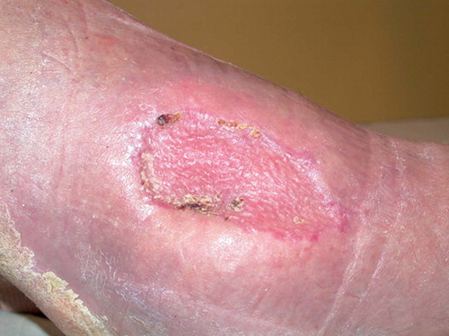 Figure 13. One month after split skin grafting.