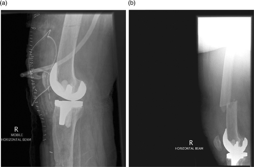 Figure 1. (a) Lateral radiograph post TKA. Cortical defects produced by a femoral tracker pin are clearly visible. (b) Fracture through the femoral pin site after a fall.