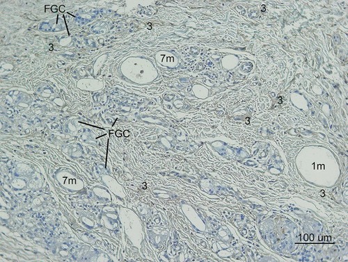 Figure 13 Type III Collagen antibody stain (100×) in the same area of Figure 11,12,14. Collagen-III fibers (3) appeared brown around and between particles (1 m, 7 m) in the dermis. The shape was in various thicknesses, from thick and densely stained Collagen-III to very thin Collagen-III fibers. Abundant type-III collagen was observed even 7 months after injection of CaHA filler and this is very first finding. This means new collagen (Type II I and I both) was created continually if CaHA particle existed. Abundant  FGCs (stained light blue) and its nuclei (dark blue) observed around smaller CaHA particles in Type-III collagen antibody stain.