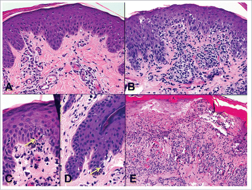 Figure 5. Epidermal inflammation (ei) and injury (e) in skin-containing VCA. A) Epidermis at 40x magnification with no epidermal infiltrate (ei0). Dilated superficial dermal capillaries with minimal perivascular inflammation are also present. B) One focus of prominent epidermal involvement without apoptosis (ei3, e0). C and D) Focal keratinocyte apoptosis (e1) (arrows). E) Frank epidermal necrosis. Moderate perivascular inflammation in the superficial dermis is also present.
