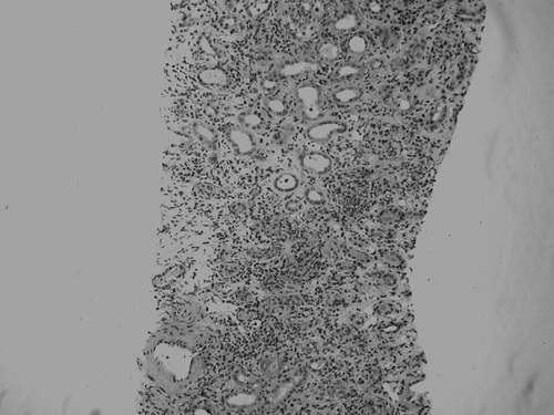Figure 2 Diffuse, severe interstitial inflammation mainly with lymphocytes and plasma cells accompanied by tubulitis (H/E stain × 100).