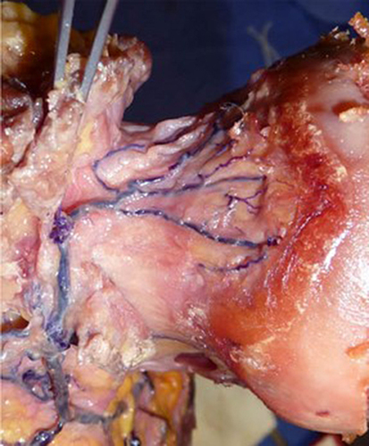 Figure 7 Anatomical dissection demonstrating the metaphyseal retinacular vessels as they traverse the femoral neck and supply the femoral head. Fracture of the femoral neck can cause rupture or shearing of the vessels, subsequently leading to AVN and mechanical failure.