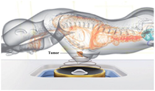 Figure 5. Treatment figure of patients with FA using Haifu system. (Zhang C, et al. Int J Hyperthermia. 2022;39(1):743-750.).