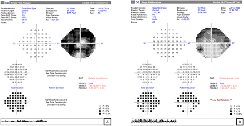 Figure 9 HFA visual field testing demonstrates superior arcuate field defect in the left eye (A). HVF testing in the right eye was not reliable (B).