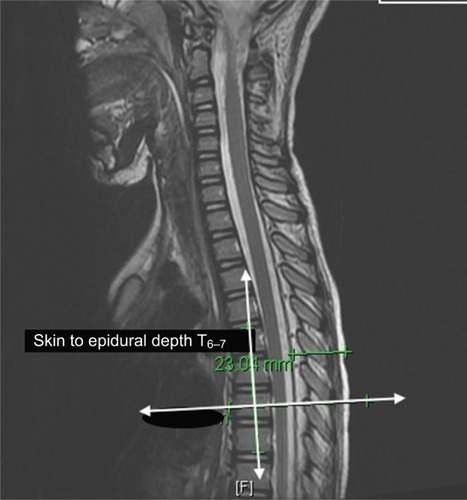 Figure 1 Magnetic resonance image of the thoracic spine and vertebral bodies showing technique for the measurement of the perpendicular skin to epidural distance at the T6–7 interspace.
