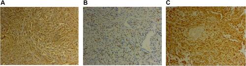 Figure 6 Immunohistochemical staining (20 X) revealed WT-1 positivity (A), GATA-3 positivity (B) and CK (pan) positivity (C).