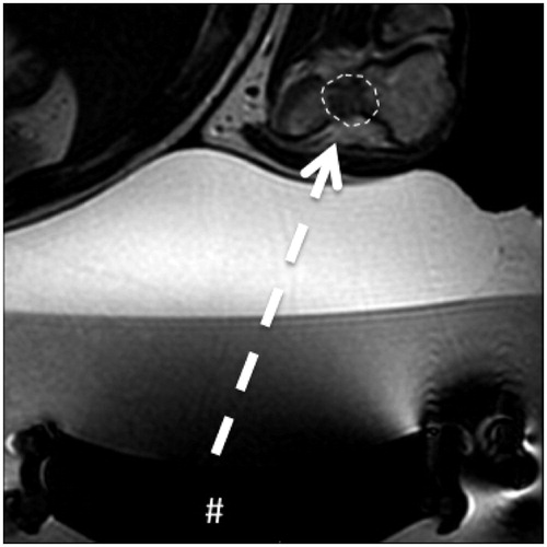 Figure 1. Intra-articular osteoblastoma of the elbow (distal humerus). Transverse T2-weighted MRI obtained during treatment: the # indicates the transducer that generates the ultrasound; the dashed arrow is the US pathway between the transducer and the lesion (dashed line) that is free from structures that could interfere with the progression of the US beam.