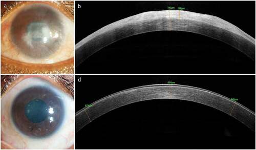 Figure 4. Clinical Outcome of Simple Limbal Epithelial Transplantation (SLET). The top row shows the pre-operative appearance of affected eye with opacification and vascularization of the corneal surface (a) and a thick bright hyperreflective conjunctival epithelial phenotype seen on optical coherence tomography (OCT, b). The same eye one-year post-operative shows remarkably improved corneal clarity, absence of vascularization and opacification (c) and smooth dark hyporeflective corneal epithelial phenotype on OCT imaging (d).