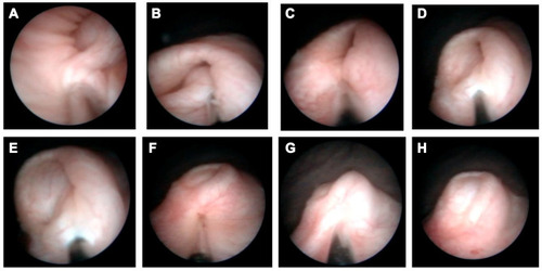 Figure 3 The latter half of SMHIT (systematic-multisite hydrodistention implantation technique) for left VUR grade Ⅳ (A and B) Third injection of Dx/HA. (C) Fourth insertion of a needle. (D and E) Fourth injection of Dx/HA (STING (subureteral transurethral injection) technique). (F) Fifth insertion of a needle. (G) Fifth injection of Dx/HA. (H) Left ureteral orifice after SMHIT.