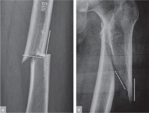 Figure 4. Measurement of fracture angle. A: atypical femoral fracture with a fracture angle close to 90 degrees measured on the proximal shaft fragment. B: fracture with an angle of about 30 degrees.