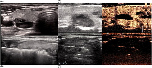 Figure 2. Ultrasonography before and after parathyroid ablation of a 56-year-old man on dialysis for seven years. (A) Ultrasonography of secondary hyperparathyroidism. (B) Ablation bubbles filled the entire parathyroid gland during ablation. (C) Preoperative CEUS showed high enhancement of the parathyroid gland. (D) Postoperative CEUS showed no enhancement of the parathyroid.