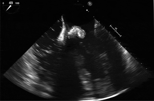 Figure 2. Trans-oesophageal echocardiogram showing mitral valve infective endocarditis