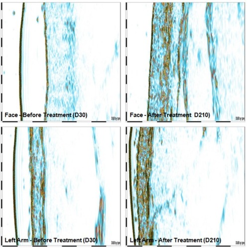 Figure 3 Collagen evidenced by ultrasound images before and after intervention.