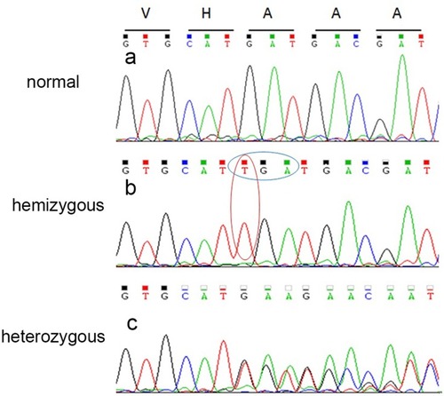 Figure 3 Sequencing results of EMD mutation. (A) Image a shows results for a normal individual. Sanger sequencing demonstrated a duplication mutation (c.405dup) in exon 5 of EMD in the hemizygous individual (B) and the overlapping peaks in the heterozygous individual (C).